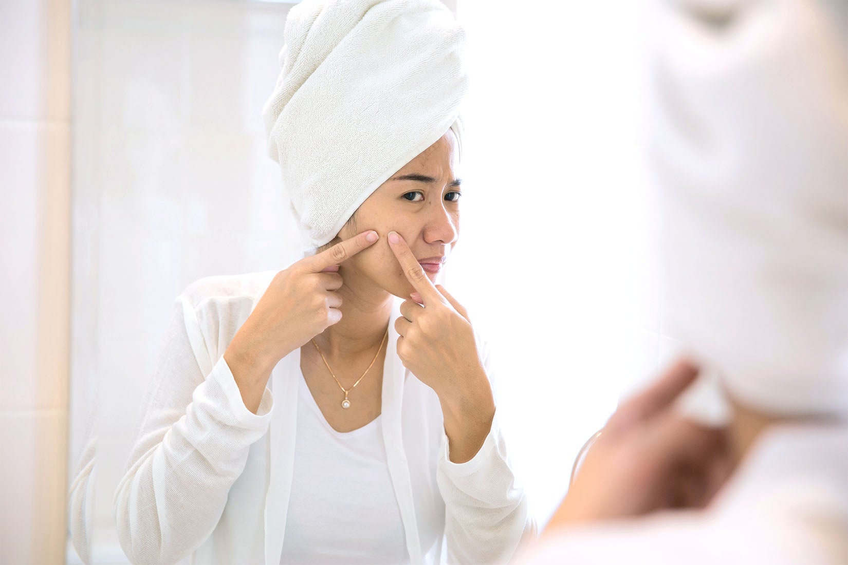 10 Facts You Need to Know About Acne